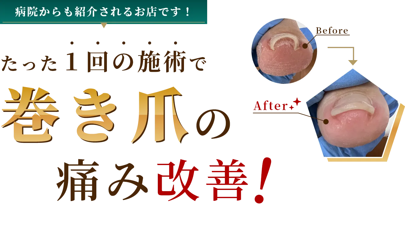 たった１回の施術で巻き爪の痛み改善！